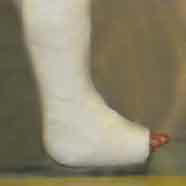 Plaster cast on a foot